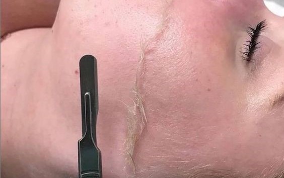 dermaplaning